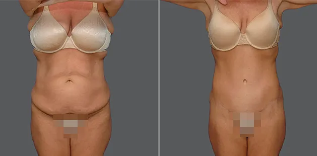 Before and after tummy tuck and body contouring as part of a mommy makeover procedure.