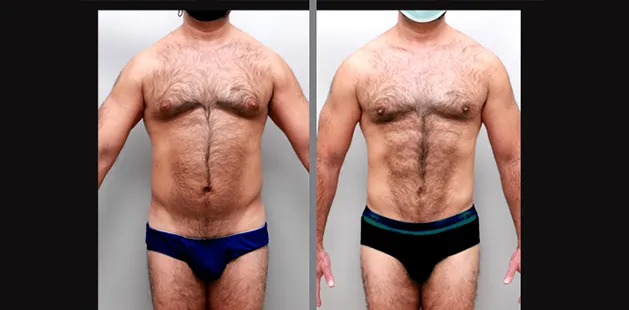 Men’s cosmetic surgery transformation showing defined chest and torso | Charlotte plastic surgery results.