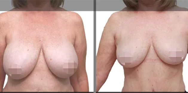 Plastic surgery results showing breast reduction and lift for improved comfort and shape.