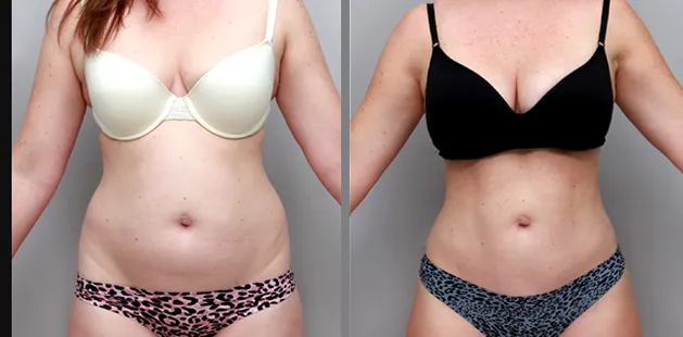 Noticeable body contour improvement after liposuction, age 31, 5'6 166 lbs, Ditesheim Cosmetic Surgery Charlotte North Carolina