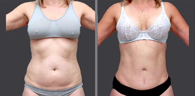 Before and after image showing tummy tuck and body rejuvenation after pregnancy.