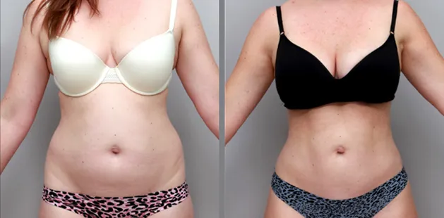 Charlotte mommy makeover results showing enhanced abdominal contour and body confidence.