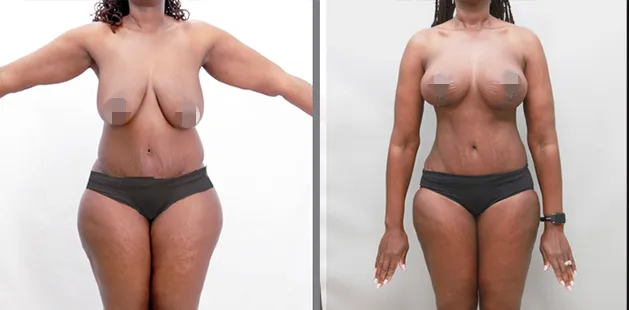 Before and after cosmetic breast reduction showing restored balance and natural body contour.