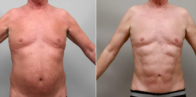 Male chest reduction and body contouring results | Plastic surgery before and after Charlotte.