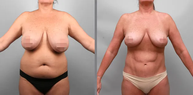 Mommy makeover showing restored body shape and tighter abdomen.