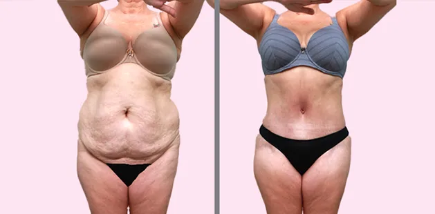 Before and after tummy tuck results showing smoother abdomen and reduced loose skin