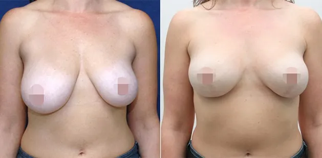 Breast lift before and after highlighting firmer, more youthful breasts.