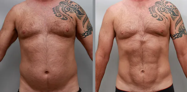 Male gynecomastia surgery results before and after | Ditesheim Cosmetic Surgery.