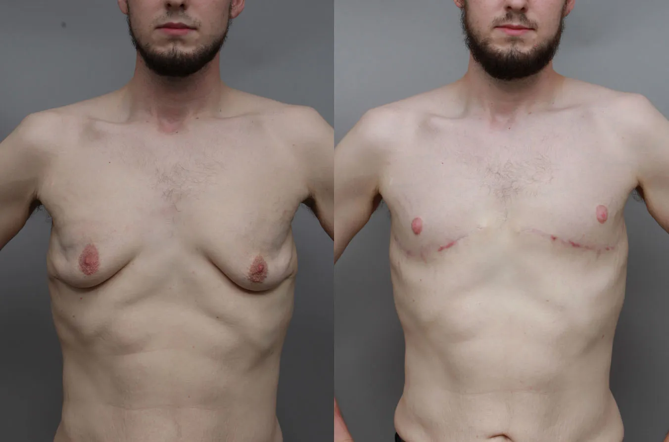 Gynecomastia surgery results before and after | Ditesheim Cosmetic Surgery Charlotte NC.