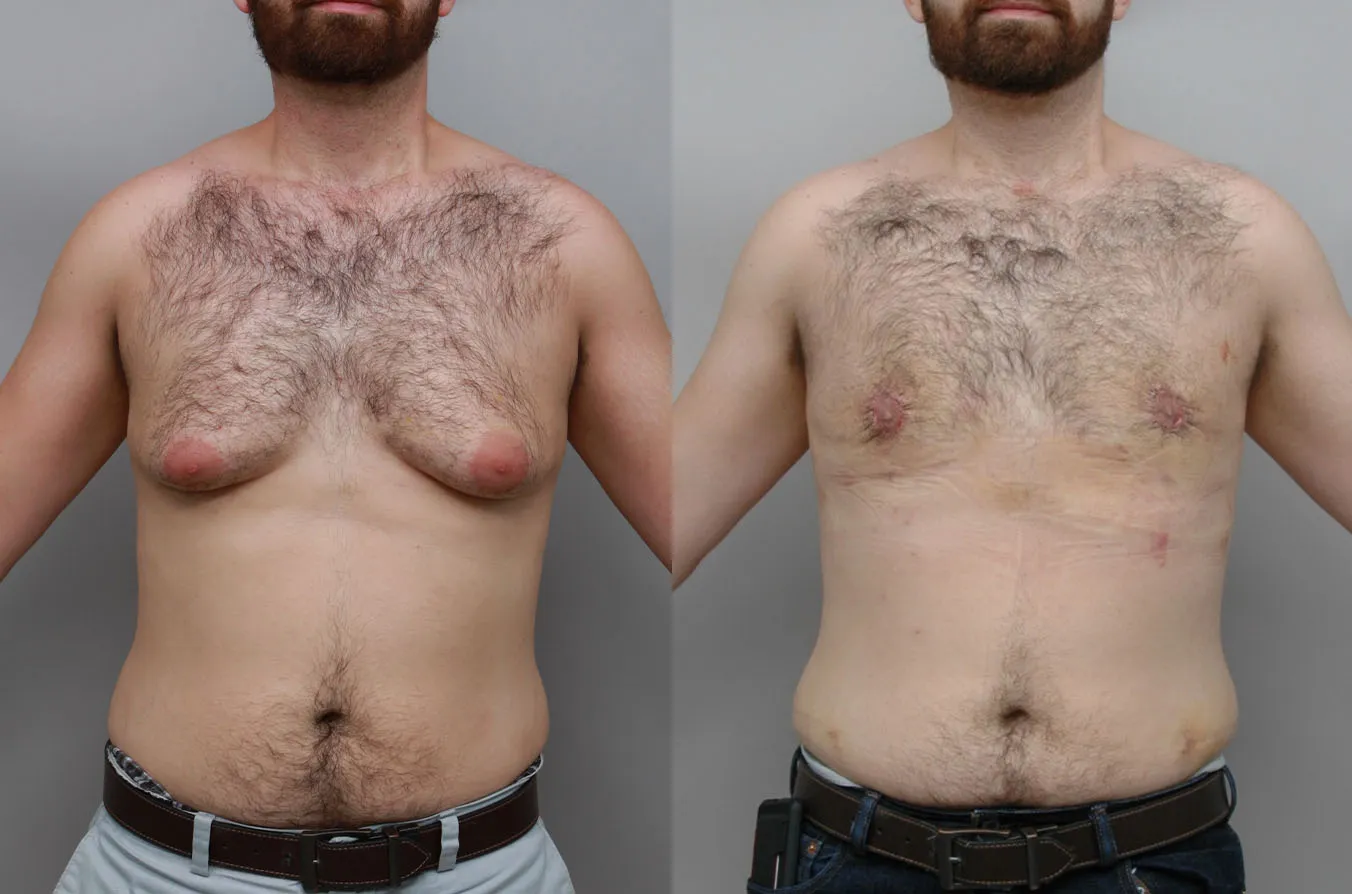 Before and after male plastic surgery showing chest contour improvement | Charlotte cosmetic surgery results.