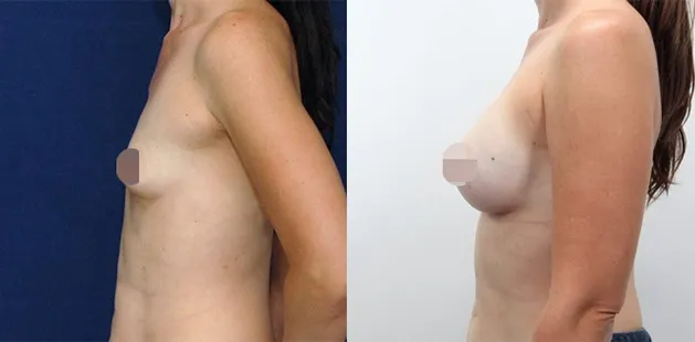 Before and after breast augmentation showing natural, fuller results at Ditesheim Cosmetic Surgery.