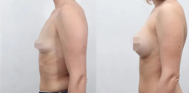 Breast implant results showing restored fullness and youthful contour at Ditesheim Cosmetic Surgery.