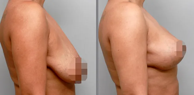Ditesheim Cosmetic Surgery before and after breast lift demonstrating refined and lifted results.