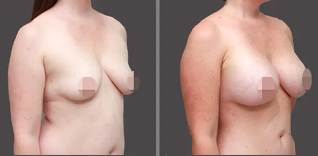 Side view of breast augmentation before and after showing enhanced fullness and lift.