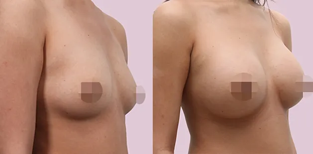 Breast augmentation results showing increased volume and balanced contour.