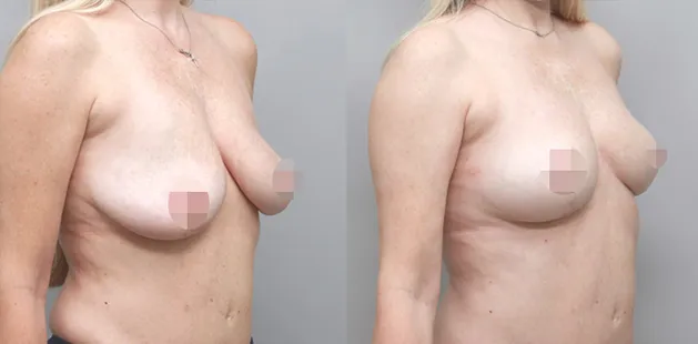 Breast lift procedure results at Ditesheim Cosmetic Surgery showing youthful, balanced enhancement.
