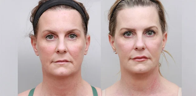 Before and after facelift and upper eyelid lift at Ditesheim Cosmetic Surgery in Charlotte NC showing reduced wrinkles and lifted cheeks