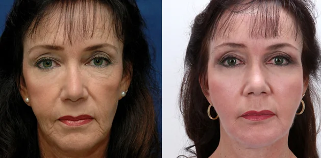 Facelift and fat grafting outcome for 59-year-old woman at Ditesheim Cosmetic Surgery, Charlotte, North Carolina