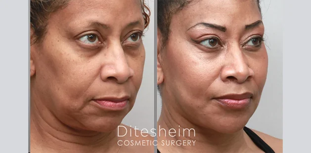 Natural facelift, fat grafting, and lip lift outcome age 52 at Ditesheim Cosmetic Surgery, Charlotte