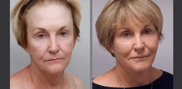 Facial rejuvenation results age 73 with face fat grafting at Ditesheim Cosmetic Surgery, Charlotte NC, showing smoother lifted complexion