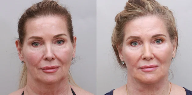Before and after facelift, fat grafting, neck lift results on 69-year-old woman, Ditesheim Cosmetic Surgery Charlotte NC
