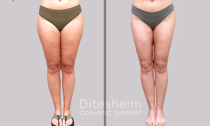 Thigh liposuction result on 41-year-old female, 5'5 136 lbs, treated at Ditesheim Cosmetic Surgery in Charlotte