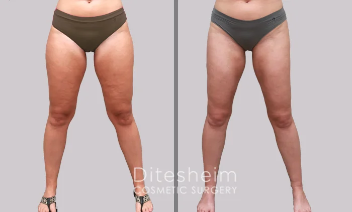 Before and after thigh lipedema surgery showing smoother, slimmer leg contours and improved symmetry | Ditesheim Cosmetic Surgery Charlotte
