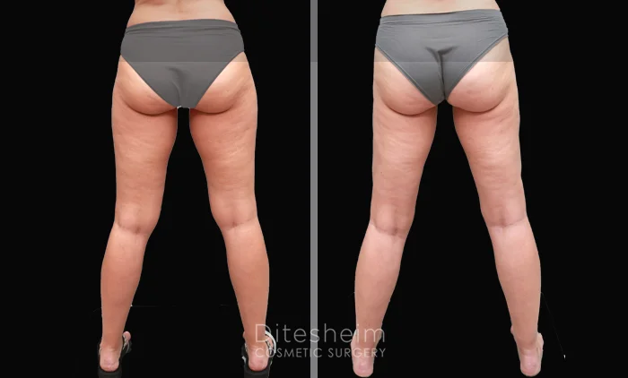 Before and after thigh lipedema surgery showing smoother, slimmer leg contours and improved symmetry | Ditesheim Cosmetic Surgery Charlotte