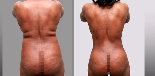 Before and after buttock lift and augmentation showing improved contour and firmness at Ditesheim Cosmetic Surgery.