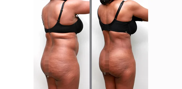 Buttock lift and fat transfer results highlighting smoother, lifted appearance.