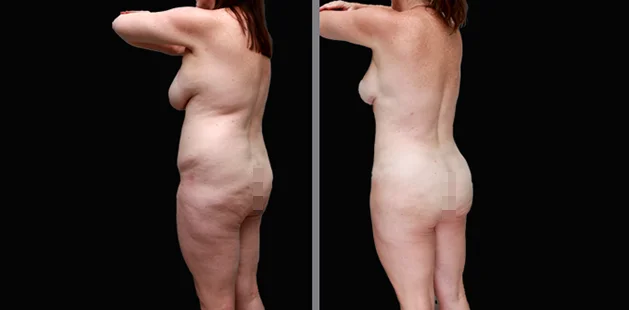 Ditesheim Cosmetic Surgery before and after showcasing real patient transformations.