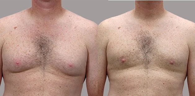 Gynecomastia surgery results with liposuction at Ditesheim Cosmetic Surgery, Charlotte NC, showing defined male chest