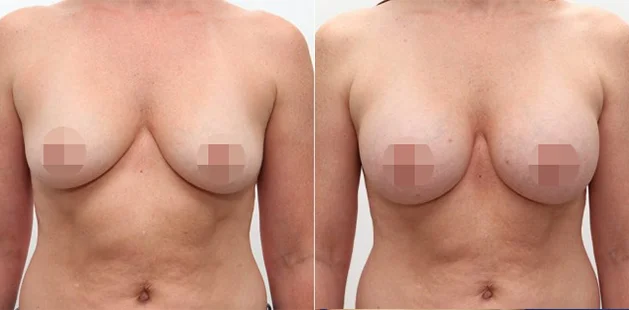 Ditesheim Cosmetic Surgery Charlotte NC breast augmentation case, 39-year-old, 5'7” 134 lbs, 36B to 36C outcome