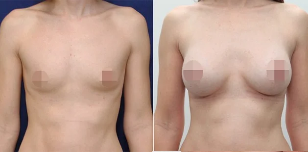 Age 34 patient breast augmentation before 34A after 34C, 5'8 125 lbs at Ditesheim Cosmetic Surgery in Charlotte NC
