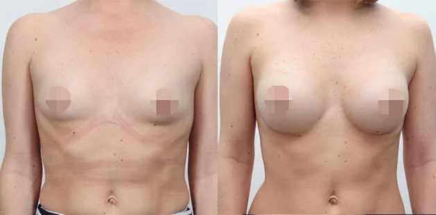 Breast augmentation results, age 32, 5'4" 120 lbs, 34A to 34C transformation at Ditesheim Cosmetic Surgery in Charlotte NC