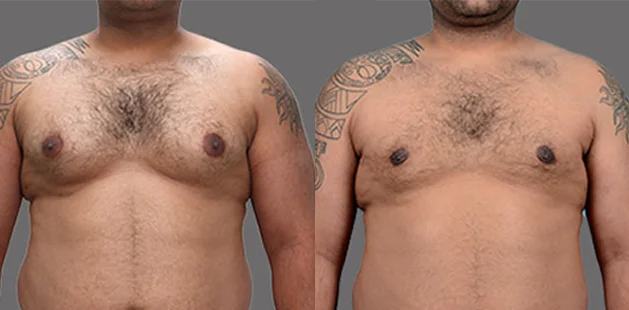 Gynecomastia surgery results with liposuction, flatter male chest contour, age 31, 5'8 236, grade 2, Ditesheim Cosmetic Surgery Charlotte NC