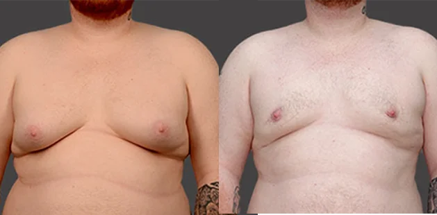 Ditesheim Cosmetic Surgery Charlotte NC male chest liposuction before and after gynecomastia surgery age 31 grade 3