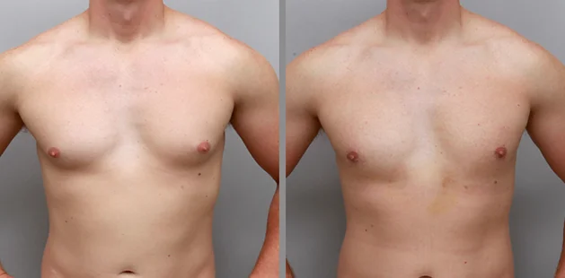 32-year-old male gynecomastia treatment before and after at Ditesheim Cosmetic Surgery, Charlotte NC, showing flatter chest contour
