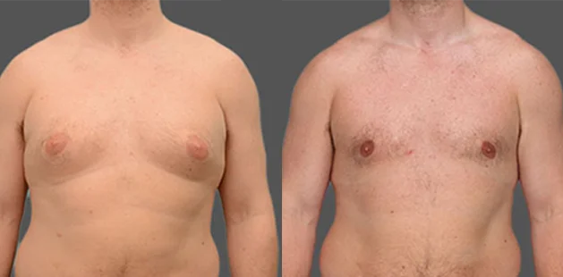 Male patient age 28, 5'11 214 lbs, Grade 2 chest liposuction result at Ditesheim Cosmetic Surgery Charlotte NC