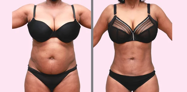 Ditesheim Cosmetic Surgery Charlotte NC liposuction results, 51-year-old patient 5'3 159 lbs to 135 lbs body transformation