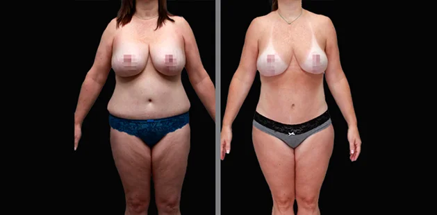 Ditesheim Cosmetic Surgery Charlotte NC liposuction and BBL full body contouring results, female age 50, 5'7 179 lbs