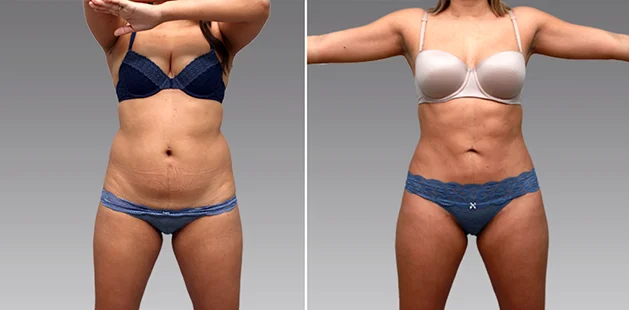 Body transformation of 24-year-old 5'3" 135 lbs patient with liposuction, tummy tuck, lipo 360 and mommy makeover Charlotte NC clinic