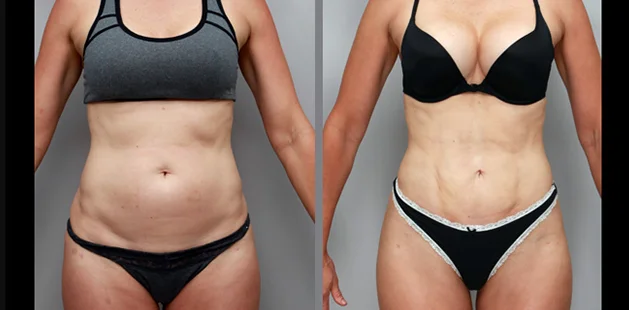 Enhanced body contour of 51-year-old after liposuction, BBL, Renuvion, mini tuck at Ditesheim Cosmetic Surgery Charlotte NC