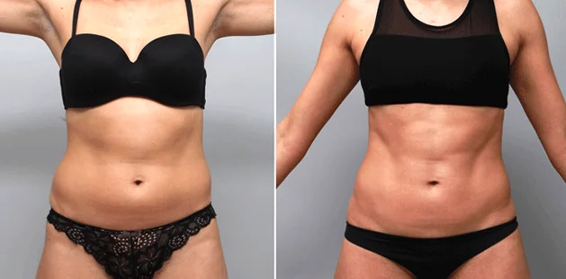 Liposuction results on 36-year-old patient (5'5", 131 lbs) showing enhanced body contour at Ditesheim Cosmetic Surgery Charlotte