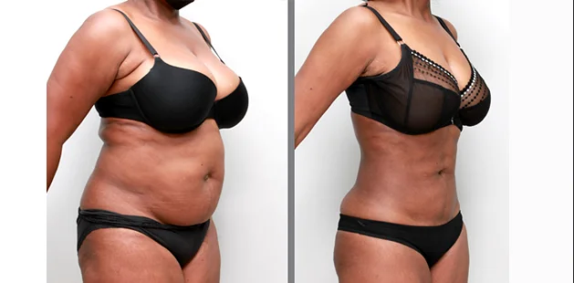 Ditesheim Cosmetic Surgery mommy makeover with tummy tuck and breast lift results.