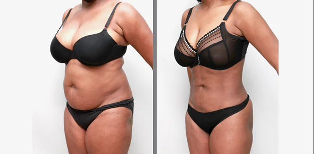 Before and after body contouring and breast enhancement after pregnancy.