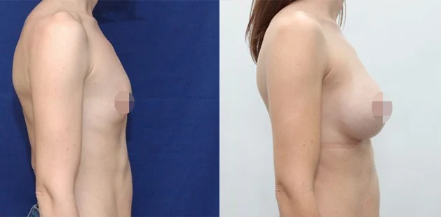 Before and after breast augmentation showing natural, fuller results at Ditesheim Cosmetic Surgery.