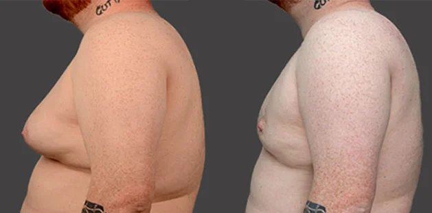 Side view of male chest before and after gynecomastia surgery, highlighting a flatter, more defined chest contour.