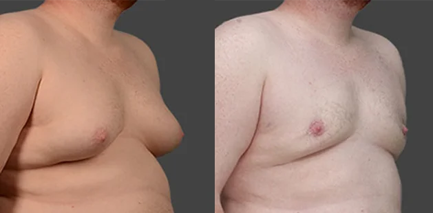 Quarter-side view of male chest before and after gynecomastia surgery, highlighting a flatter, more defined chest contour.