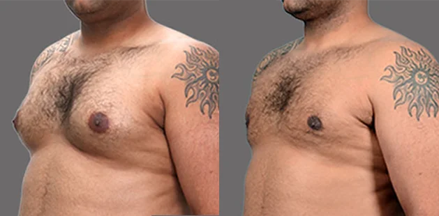 Quarter-side view showing male chest before and after gynecomastia surgery, revealing a smoother, more sculpted chest appearance.